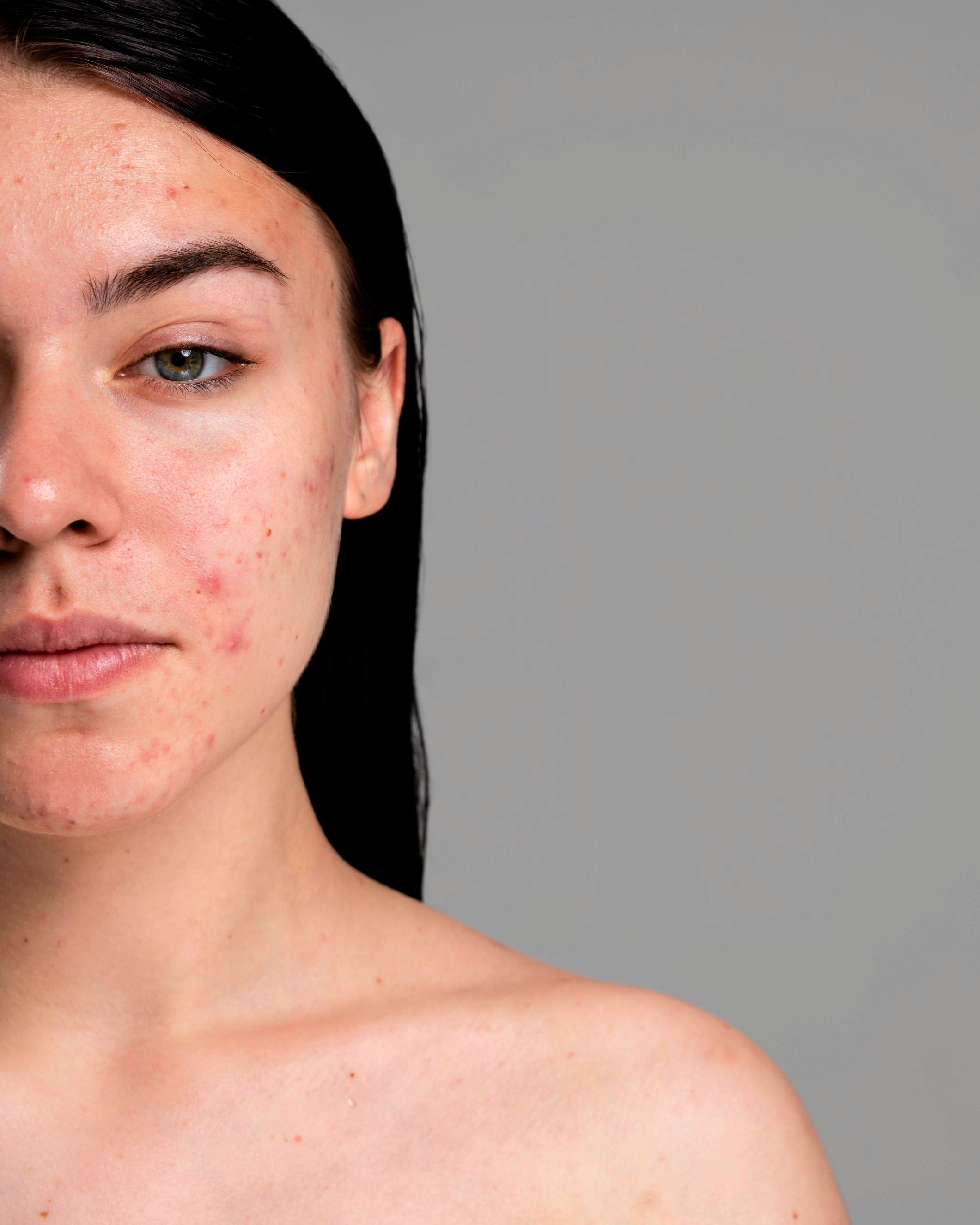 young woman showing her acne with confidence kopie